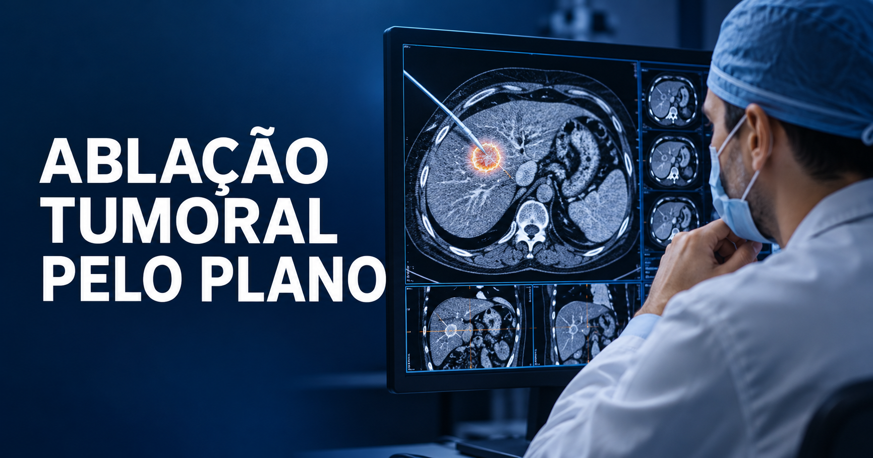 Ablação tumoral por radiofrequência ou micro-ondas: quando o plano deve cobrir?